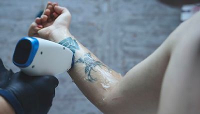 Tattoo Removal: Everything You Need to Know
