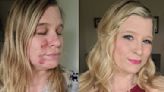 Cystic acne left woman too self-conscious to leave the house – what is the condition?