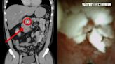 4旬男工作常酗酒牛飲！胰管竟生1公分大結石「無法站立、一吃就吐」