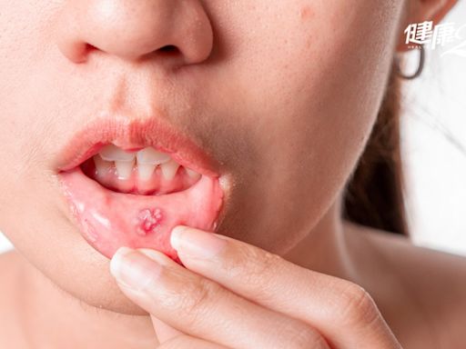 權威研究警告：口腔潰瘍別再用這種牙膏！嘴破快速癒合靠1招＋3食物