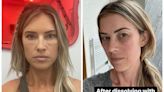 Christina Hall says she won't use under-eye filler again after experiencing an 'inflammatory reaction'