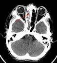 Sinusitis