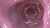 It May Be Safe to Extend Time Between Colonoscopy Screenings, Study Says