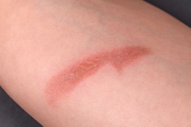 First-Degree Burn: Healing the Skin Surface