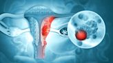 Científicos de Mayo Clinic desarrollan pruebas caseras para cáncer de endometrio y ovario con hisopo