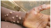 Mpox infections double last year's rate