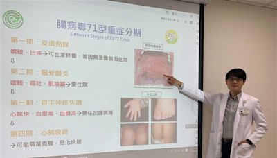 暑假腸病毒大流行「7成孩童感染」 3兄弟同時中鏢嘴痛爆、口水狂流