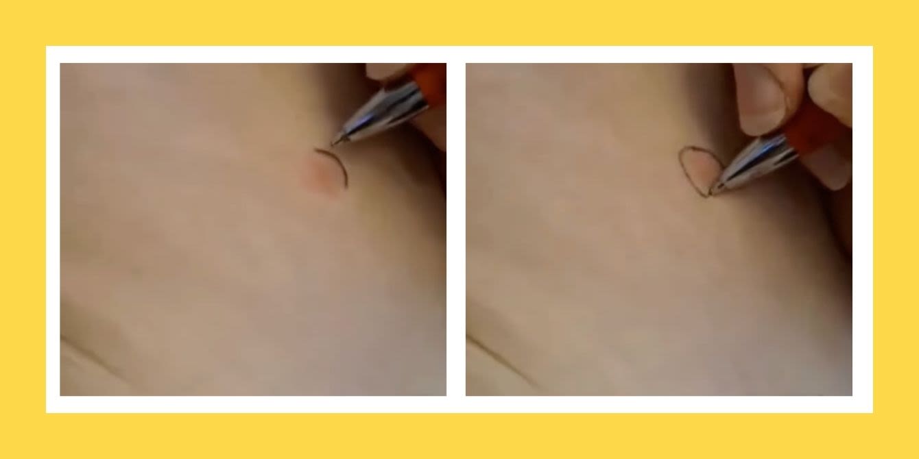 This ‘pen trick’ is a must-know for parents heading into bug bite and rash season