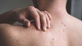 More Than Half of Melanoma Diagnoses in the U.S. Are Unnecessary, Study Finds