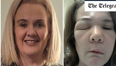 ‘I looked like The Elephant Man’: Life with extreme swelling disease HAE