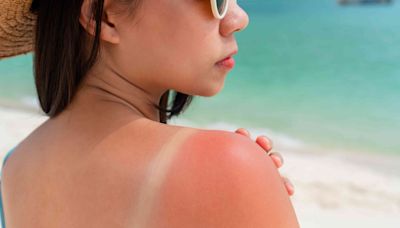 Signs and Symptoms of Sun Poisoning