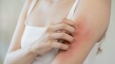 皮膚癢常見7原因 醫：小心是腎臟病警訊 - 健康