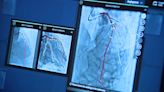 Bay Area hospital using AI technology for new cardiac procedure