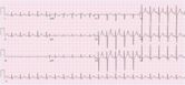 Sinus tachycardia