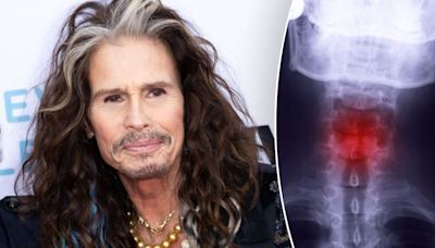 Steven Tyler’s career-ending throat injury: How dangerous is a fractured larynx?