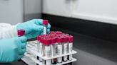 Blood Test Identifies Alzheimer’s With 90% Accuracy