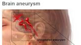 Mayo Clinic Minute: The difference in brain aneurysms - Mayo Clinic News Network