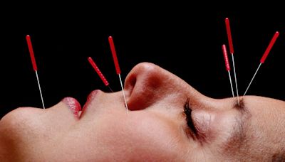 "I tried cosmetic acupuncture to help with my rosacea – here's what happened"