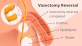 How Successful Is Vasectomy Reversal?