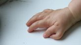 Raro caso de polidactilia: niña nace con 26 dedos en manos y pies
