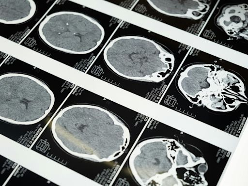 Alzheimer: estudo pioneiro da revista Nature é despublicado em ação rara; entenda