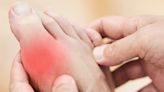 Why anyone can develop gout – and what you can do to treat it