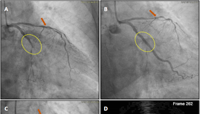 Timely collaboration: Ashland UH Samaritan cath lab treats heart attack as it was happening