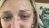 Gabby Petito's family released photos of her bruised face, saying Utah police ignored evidence that Brian Laundrie was abusing her