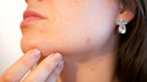 Omega-3 fatty acids, plant-based diet can improve acne, study shows