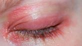 What Is Blepharitis (Eyelid Inflammation)?