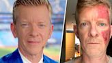 Sports anchor shares startling photo of pre-skin cancer treatment: 'I look barbecued'