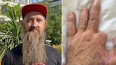 Dad who accidentally sawed his fingers off returns to carpentry after transplant