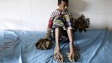 El desesperado pedido de El hombre árbol a los médicos tras someterse a 25 cirugías en sus manos
