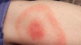 Researchers find new treatment path for lasting Lyme disease symptoms - ET HealthWorld