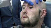 Man receives first whole eye transplant after losing half his face