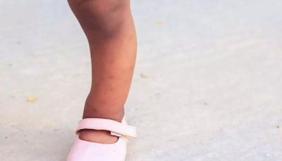 Cases Of Rickets Causing Severe Bone Issues, Seizures In Kids Soar 380 Percent In The UK