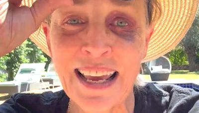 Sharon Stone Explains How She Got a Massive Black Eye