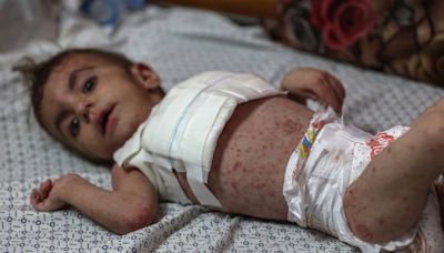 Dangerous Skin Diseases Spreading Among Malnourished Children In Gaza