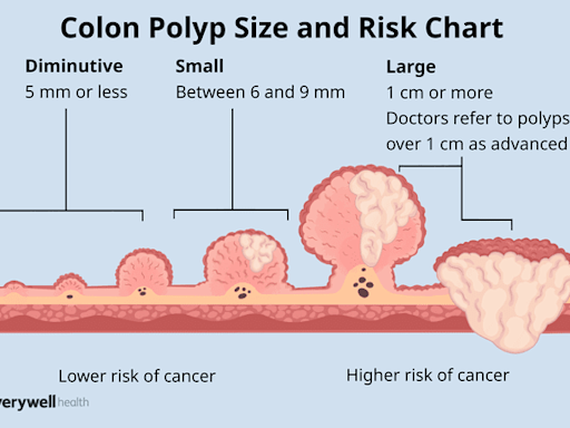 Colon Polyp Size Chart to Gauge Risk