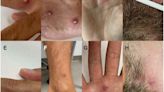In one day, a man was diagnosed with monkeypox, HIV, and COVID-19
