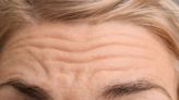 How To Get Rid of Forehead Wrinkles Over 50