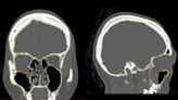 壯男騎車出車禍眼窩骨碎裂「眼球往下掉」出現殘影險失明！醫1招救了他