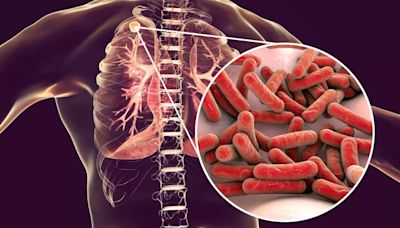 Tuberculosis: Symptoms, Causes, Prevention About The Disease