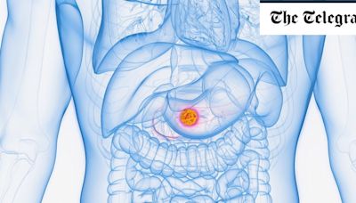 Pancreatic cancer: Symptoms, causes and treatment