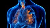 Bronchoscopic Lung Reduction Could Benefit COPD
