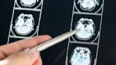 ¿Cuáles son los síntomas de un tumor cerebral?
