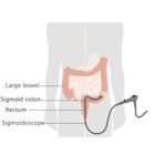 Sigmoidoscopy