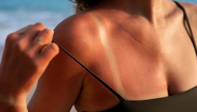 Remedios caseros para aliviar las quemaduras del sol en la piel