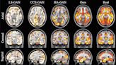 AI brain images create realistic synthetic data to use in medical research