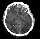 Traumatic brain injury